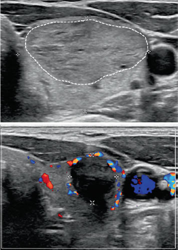 Résultat échographique après traitement d'un nodule thyroïdien par radiofréquence