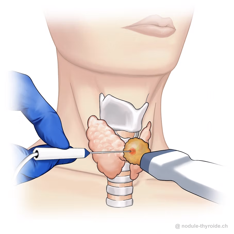 Illustration du traitement par radiofréquence d'un nodule thyroïdien