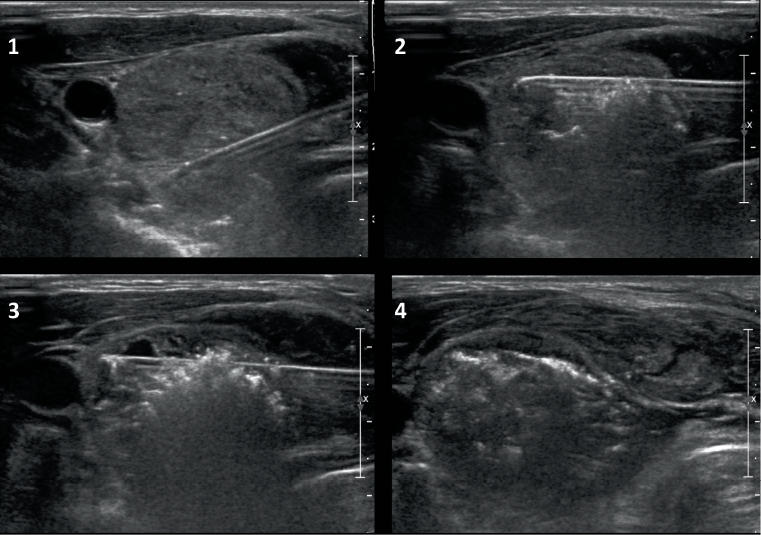 Vue échographique du traitement par thermoablation d'un nodule thyroïdien